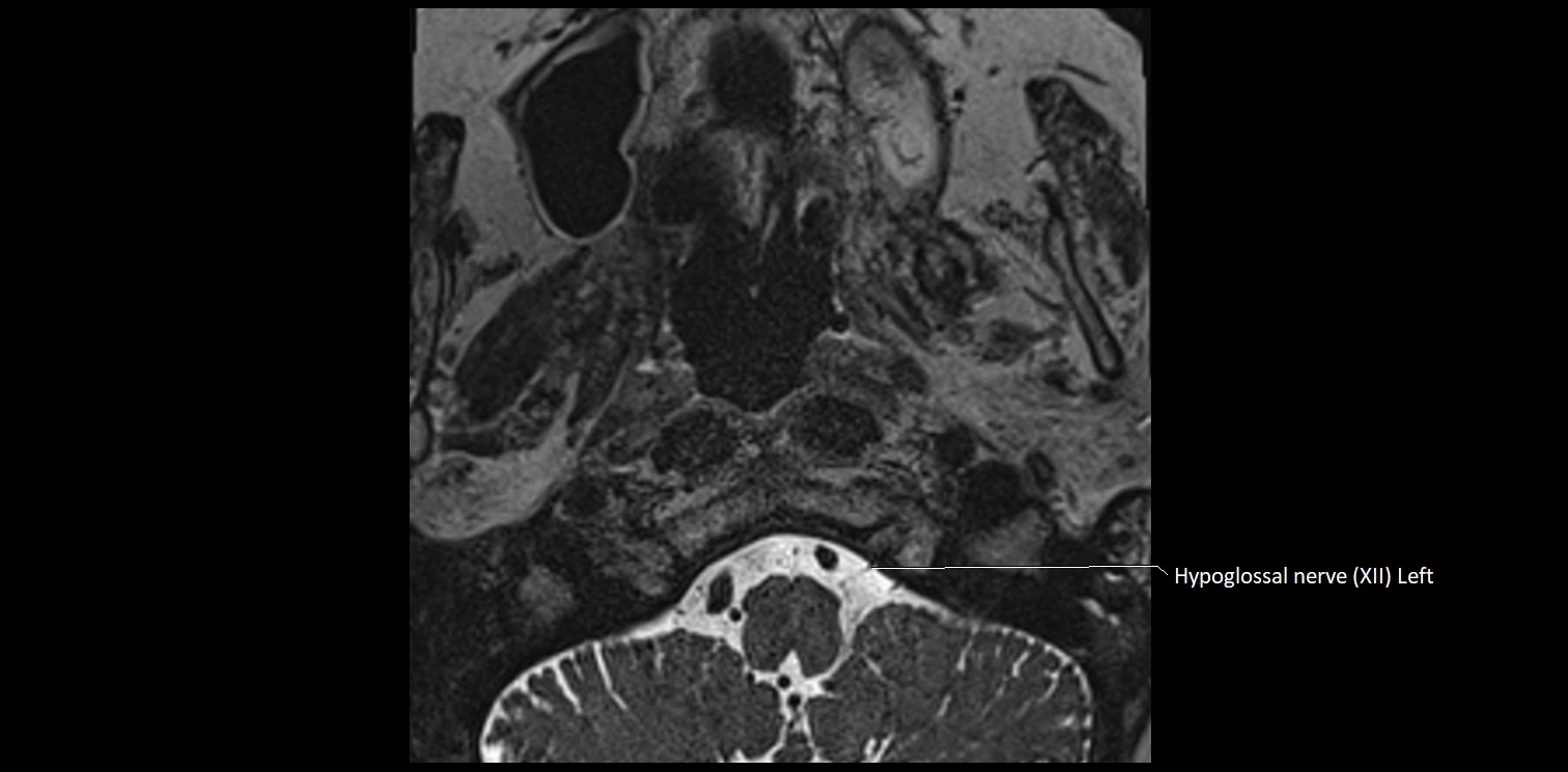 Cranial nerve anatomy axial MRI 3T image 81.webp